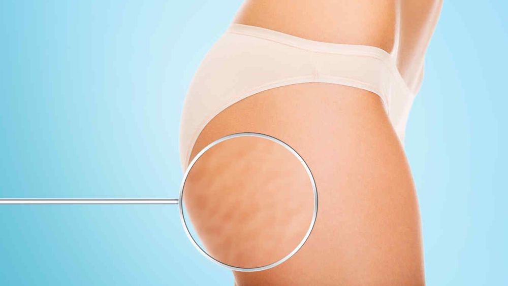 Protocolo anticelulitis para lograr una piel más tersa y con mejor textura