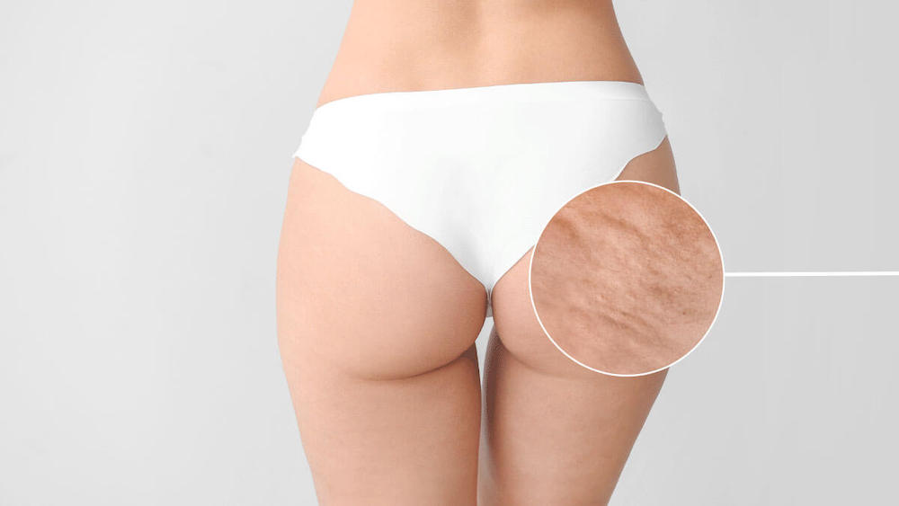 Procedimiento para combatir celulitis y mejorar la apariencia general de la piel