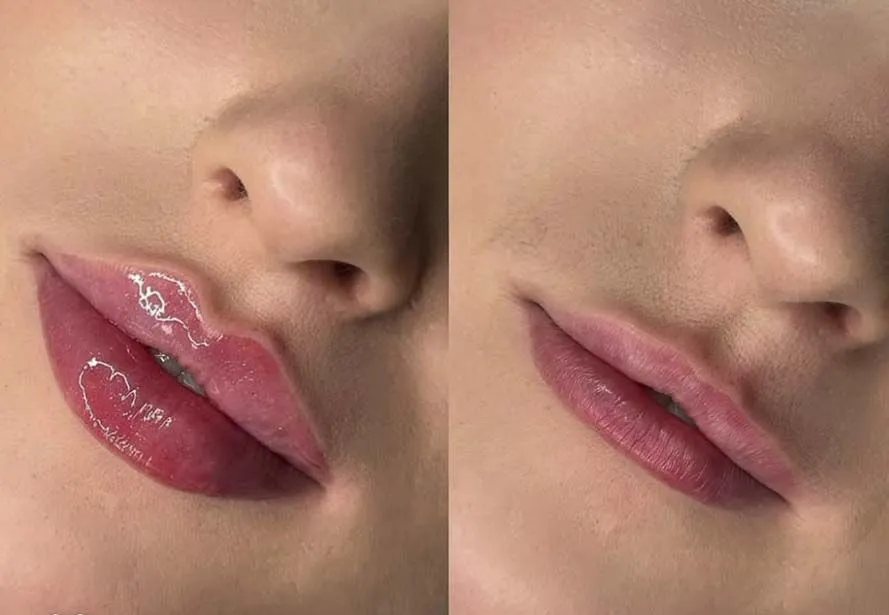 Aumento y perfilado de labios con ácido hialurónico para dar volumen, definición y simetría natural