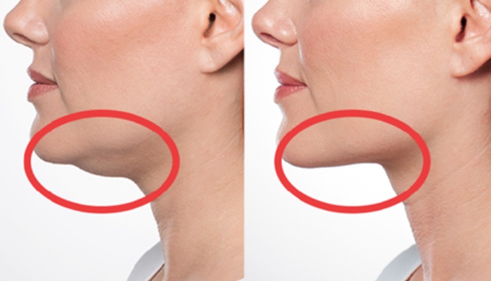 Procedimiento enzimático para papada que mejora líneas del cuello y reduce volumen adiposo sin cicatrices