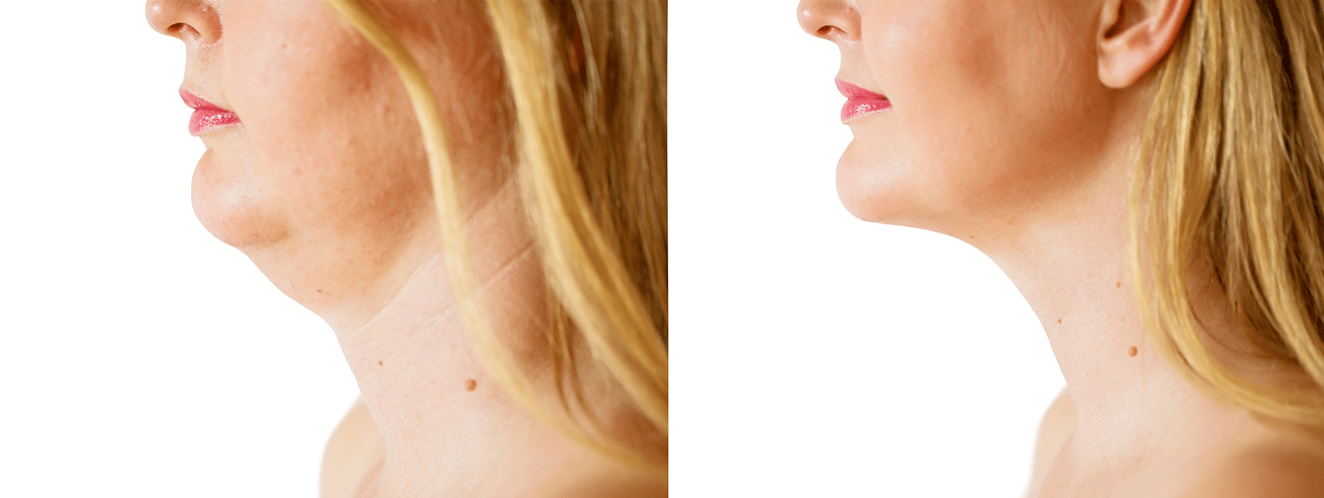 Lipopapada con enzimas para afinar el ángulo cervicomentoniano y armonizar el contorno facial rápidamente