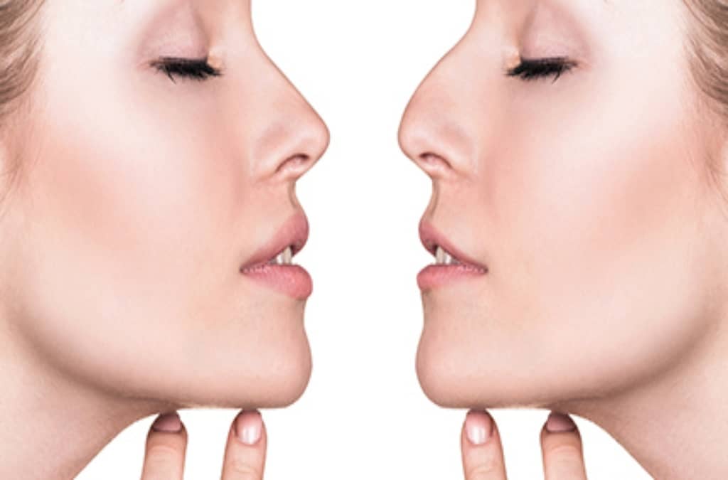 Corrección estética de punta y dorso nasal con rellenos dérmicos, logrando un contorno más equilibrado