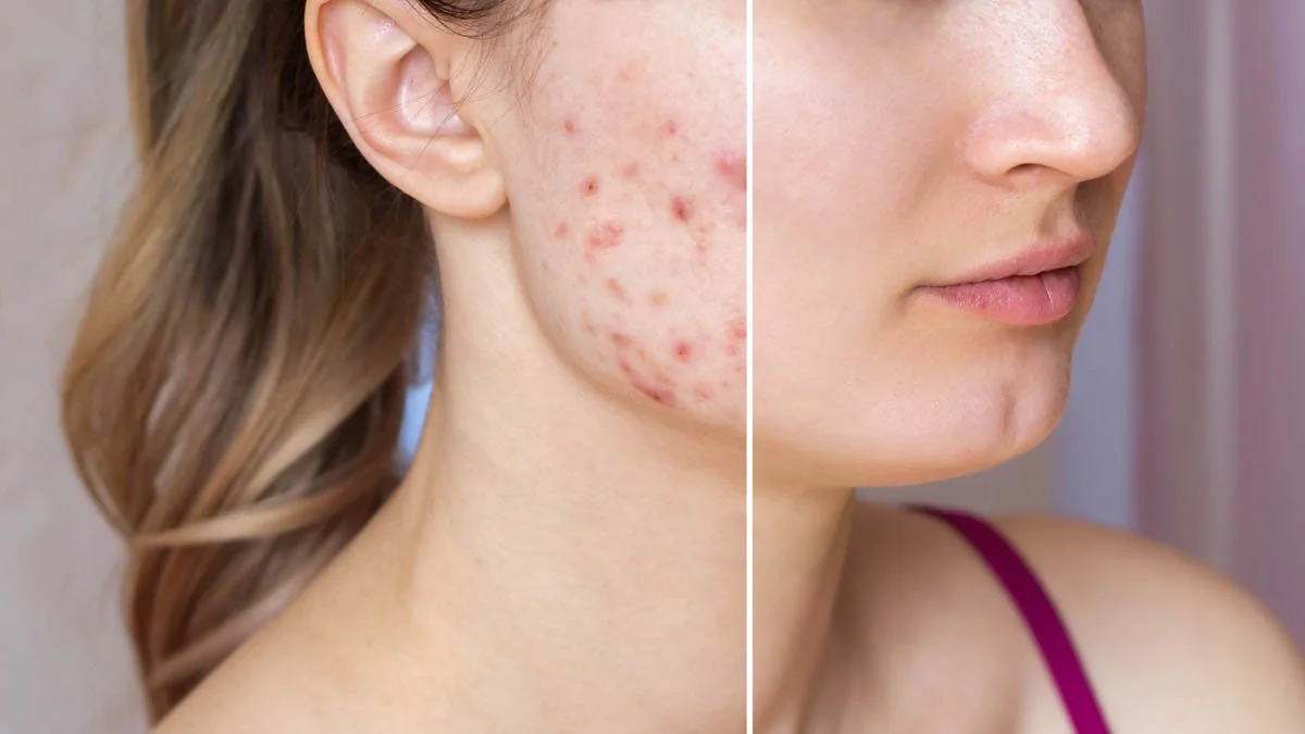 Protocolo facial antiacné con propiedades antimicrobianas y calmantes para la piel