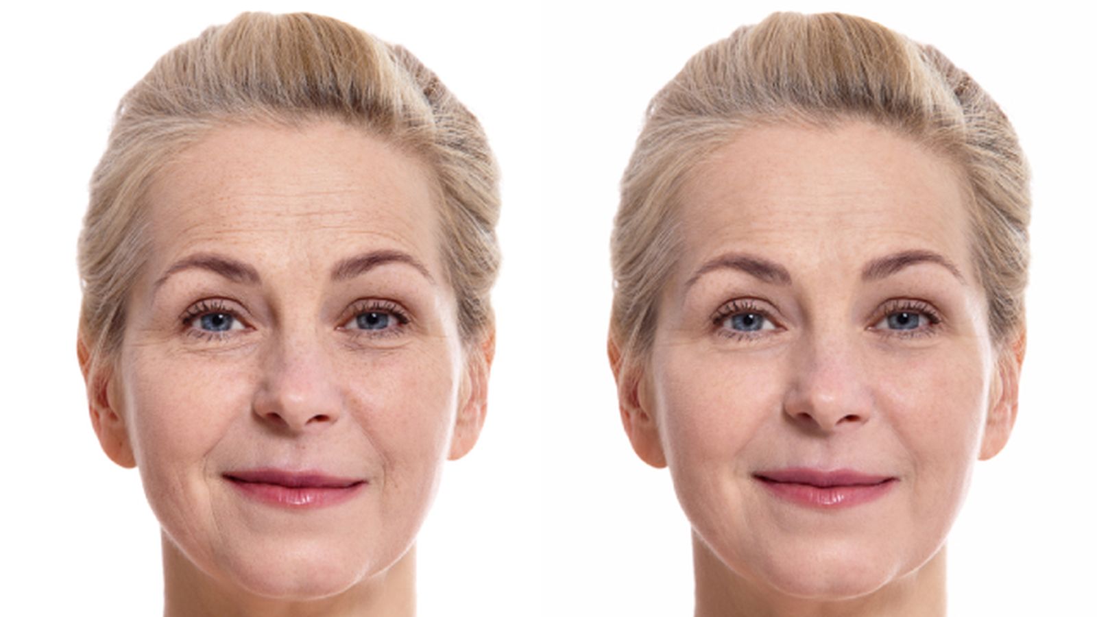 HIFU Face Lift en clínica estética Vitaplace para lifting facial sin cirugía