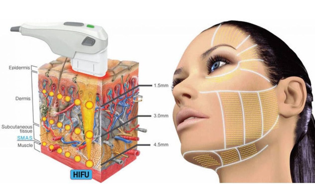 Paciente en sesión de HIFU Face Lift para tensar mejillas