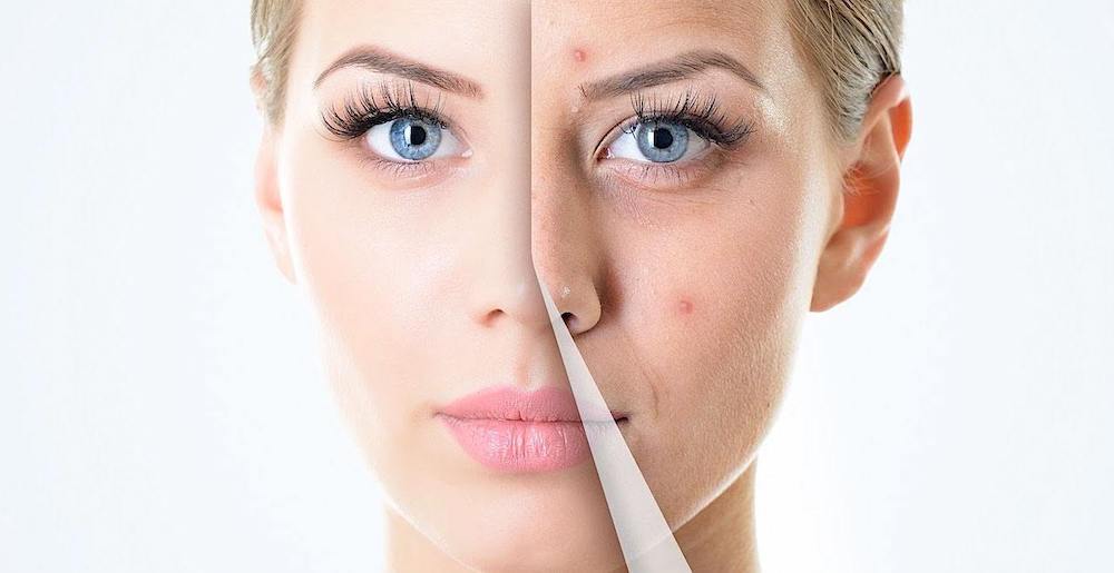 Terapia de renovación cutánea para lograr piel más luminosa y joven