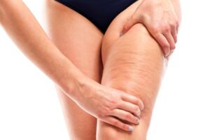 Descubre cómo eliminar la celulitis, con Clínica Vitaplace, Viña del Mar