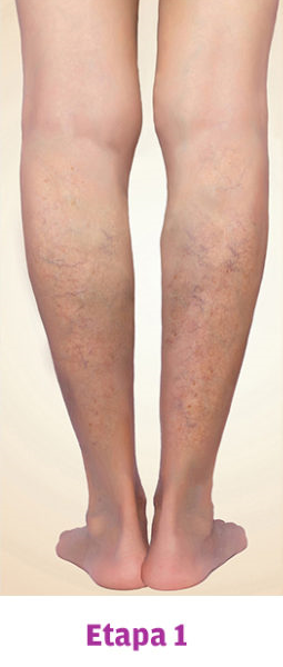 Grado 1 Varices