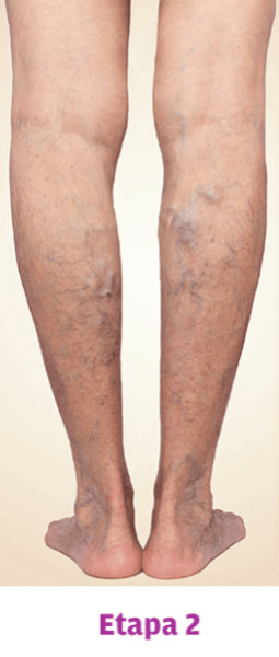 Grado 2 Varices