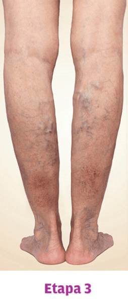 Grado 3 Varices