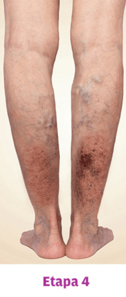 Grado 4 Varices