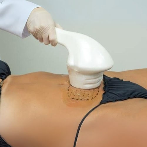 HIFU LipoMax