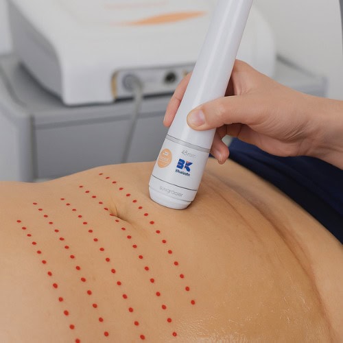 HIFU Lift Pro Corporal