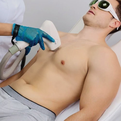 Depilación Láser Masculina DIODO