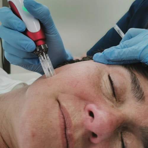 Microneedling Facial