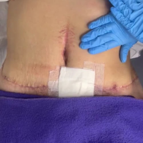 Post Operatorio Corporal