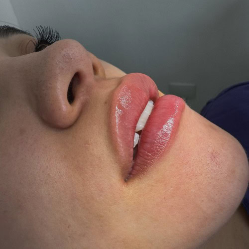 Aumento Perfilado Labios Hialurónico