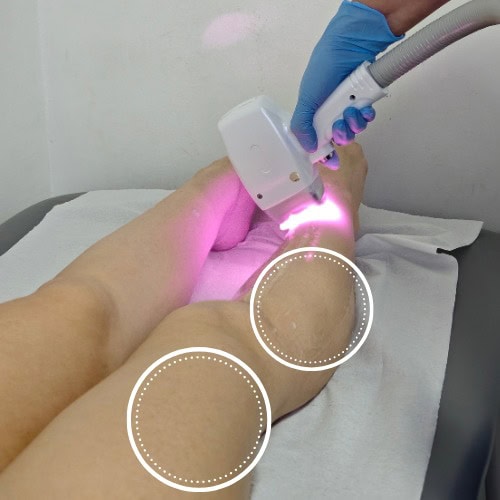 Depilación Láser DIODO Piernas Completas